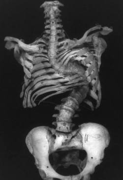 asapscience:  A spine after severe and untreated scoliosis. This condition affects about 7 million people in the United States. An estimated 65% of scoliosis cases are idiopathic (unknown cause).