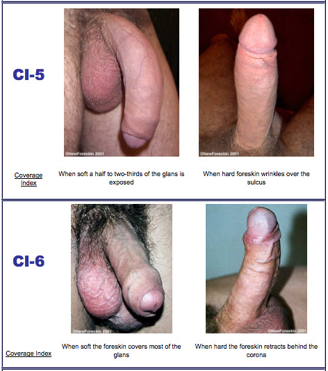 sissybentcock:  mjdwarner:  Introducing the Foreskin Coverage Index (FCI)!  This index measures how much foreskin your penis has, from 1 (completely circumised) to 10 (foreskin overhang, even when soft). Which CI is YOUR penis? 