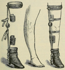 sutured-infection:   Deformity apparatus: Chas. F. Stillman’s long bow-leg braces. 1893 medical supply catalogue.  