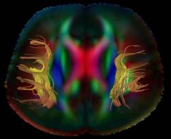 scienceyoucanlove:  Use of a personalized brain imaging technique called diffusion tensor imaging (DTI) better preserves language, visual and motor function of the brain while removing cancerous tissue.  In the latest issue of Neurosurgical Focus, researc