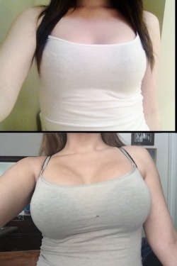 kattnippxo:  Before and after my Breast Augmentation! Before surgery I was a 34A, I got 500ccs, smooth rounds, gummy bear gel under the muscle, incision under the breast. Today is 5 days post op and Iâ€™m filling out a 34D now! So happy with my boobs