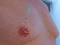 needle in my tit