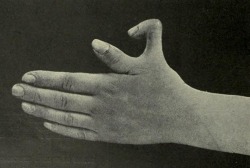 Supernumerary thumb, from Edward M. Foote’s A text-book of minor surgery, 1909