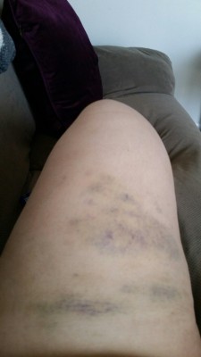 kneel-serve-and-obey:  Steel cane bruises, day 3. This picture doesn’t even properly do justice to how purple my thigh is.   @laurenethedream what’s a girl to do?  Oh…I legit just remembered that partway through the caning he also took his belt
