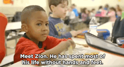 Huffingtonpost:  Watch: Boy, 8, Is First Child Ever To Receive Double Hand Transplant“Never