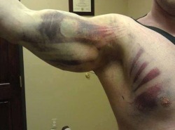 yourackdisciprine:  buried-in-the-snow:  bubblyambii:  My cousin got hit by a truck. He’s fine nothing broken but he has the sickest bruise ever!! Like holy shit you can see the outline of his muscles and bones on his chest? This thing is awesome. 