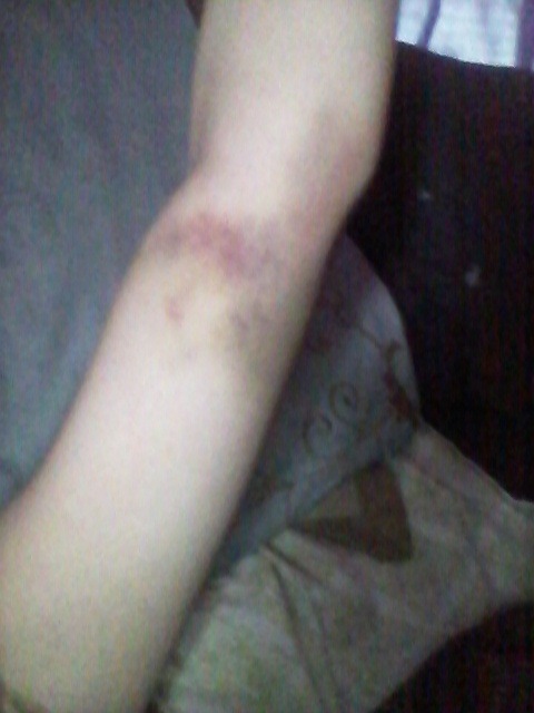 XXX bad quality bruises photo
