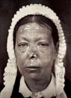 Ozena: Tuberculosis of the Nose, Circa 1870.The dreaded infection ‘Ozena’ was an ailment of much prominence in the pre-antibiotic era because it accompanied many infectious diseases of the nose. The infection of the nasal cavities resulted in a foul