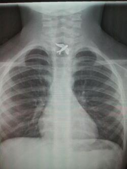 i-d-come-for-you:  rautical:  the-absolute-funniest-posts:  leftbehindtime: a girl swallowed a charm from her necklace and had to go to the emergency room One of the best x-rays ever. Jealous.  I’m going to start swallowing cool shit so i can have pretty
