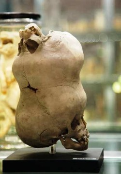 The skull of a young boy with a second imperfect skull attached to its anterior fontanelle. Hunterian Museum in London, England (late 1780s)