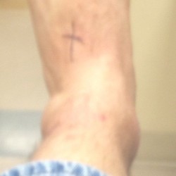 The swollen ankle at the ER yesterday