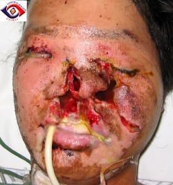 A 16 year-old male student was playing with firecrackers at home when one of them exploded in front of his face causing severe damage to the midface with loss of the nose and upper lip. The left globe was severely ruptured and required evisceration. Fortu