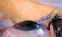 eyedefects:  Laser eye surgery 