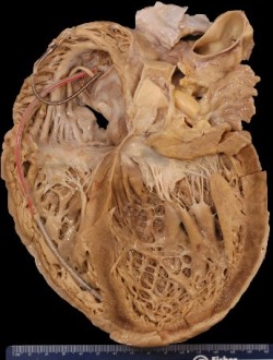 deformutilation:  Pacemaker leads showing in the cross-section of a heart 