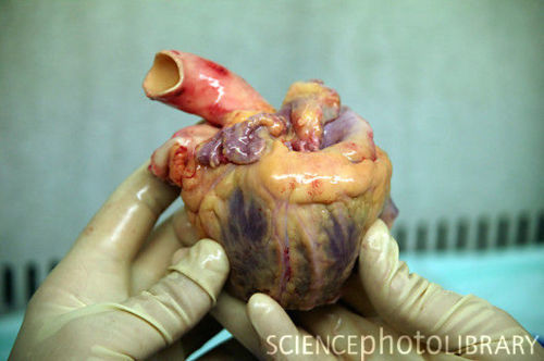 fyeahanatomy:  Human heart prior to dissection in a tissue bank. Parts of a heart