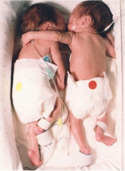  Esta foto é de um artigo chamado “O Abraço Salvador”. O artigo detalha a primeira semana de vida de um par de gêmeos. Cada um estava em suas respectiva incubadora e uma não tinha expectativa de vida. Uma enfermeira do hospital lutou contra as