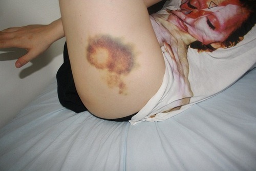 I really like bruises. adult photos
