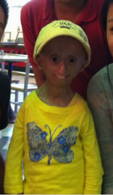 aimez-vous:  Today, I met a very special girl. I was at the mall with my brother shopping and while we were at the food court, we saw this little girl. Her name is Hana. She is THE ONLY person in California who is diagnosed with Progeria. Just last night
