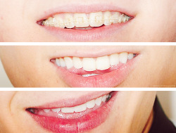 1d-foreever:  marryingthesefive:  wow. Niall’s teeth became