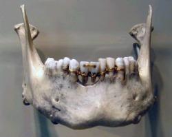 The earliest evidence of ancient dentistry we have is an amazingly detailed dental work on a mummy from ancient Egypt that archaeologists have dated to 2000 BCE. The work shows intricate gold work around the teeth. This mummy was found with two donor