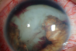 eyedefects:  Traumatic cataract and iris trauma