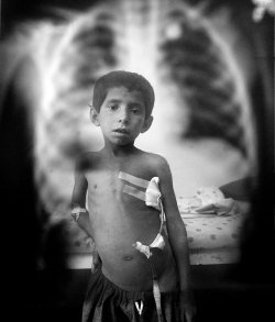 Warwithinaframe:  Attiullah,7, Is Seen Posing In Front Of An X-Ray Of The Bullet