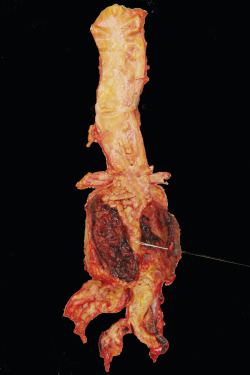 medicalschool:  This is an image of a ruptured abdominal aortic aneurysm found at post-mortem of a 65-year-old. The patient had suddenly developed severe abdominal pain and collapsed. On arrival in hospital the patient was in severe shock, rapidly deterio