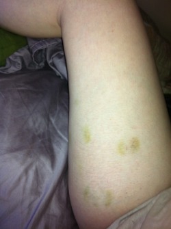 Sex bruises :) Sex bruises are the best kind of bruises! Thanks for sharing :)