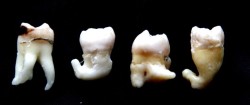 Extracted Wisdom Teeth with wrapped roots