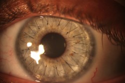 uncacti:  woodmagnet:   My girlfriend recently got a cornea transplant. Here is a high res image of the stitches in her eye  Found on Brickflow Whoa 