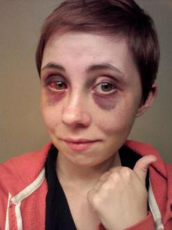 irenestraddler:  Okay, I wish I would NEVER have to make a post like this.. but here it is. That’s Emily, a girl I’ve known for about 10 years. That’s her face a couple of days after her boyfriend beat the shit out of her. She has to get facial