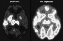 bloody-truth:  My psychology teacher showed us this picture in class and spent a good 10 minutes talking about how depression is a disorder, a mental disease, not a choice, etc. I respect him so much for that. 
