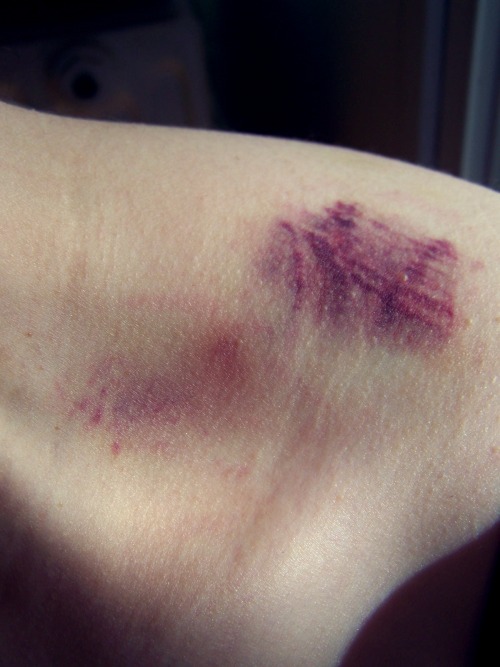 I love bruises. Marks of all kinds, really. The best sex requires neosporin and a day or two of recovery. 