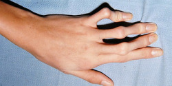 motherapist:  Arachnodactyly (“spider fingers”) is a condition in which the fingers are abnormally long and slender in comparison to the palm of the hand.