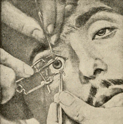 sutured-infection:  Irridectomy, from Henry D. Noyes’s A textbook on diseases of the eye, 1890 