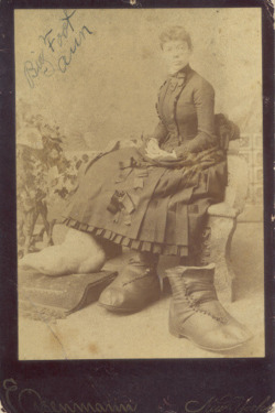 Big Foot Ann - Elephantitis Feet, 1891.
